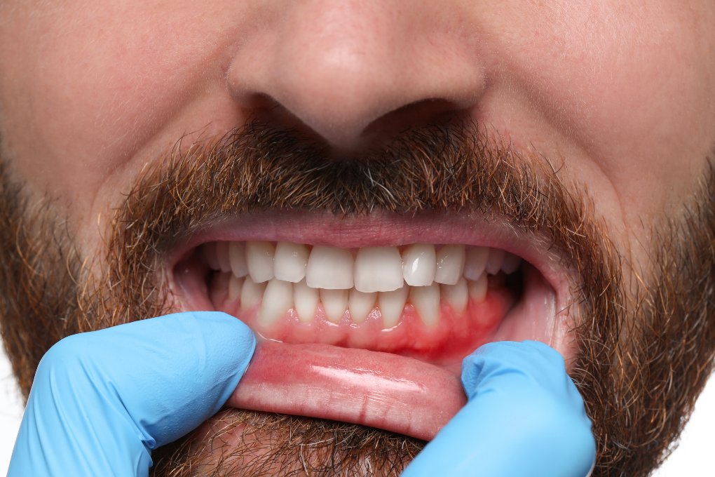 bleeding gums