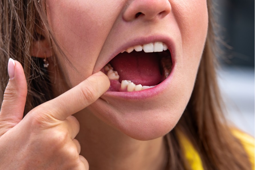 broken tooth